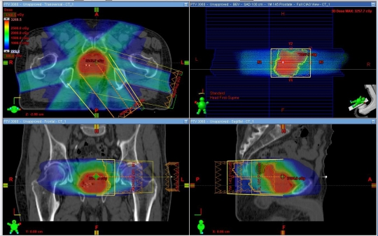 IMRT con multileaf - Radioterapia de Intensidad Modulada