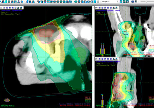 Software MIRS (Module Integrated Radiotherapy System)