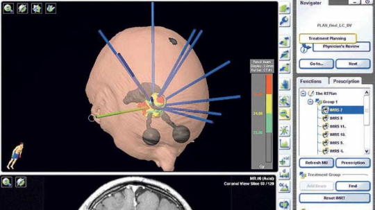 Radioneurocirugía y Radioterapia Estereotáxica